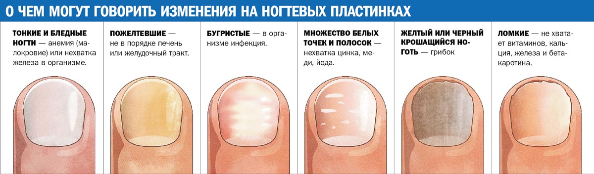 Mikozės ant nagų schema Mikozės ant nagų schema